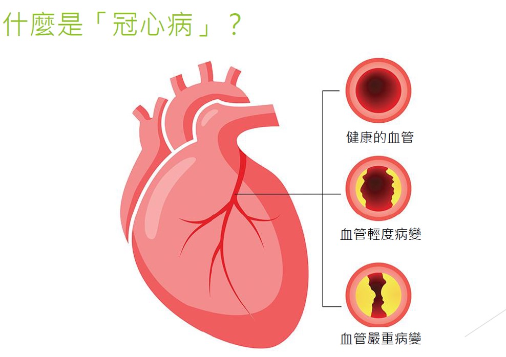 3æå å¿çæ£æ¼ç«ææå»¶å¥é¢æ­»äº¡çåå¢- é«+So Healthy