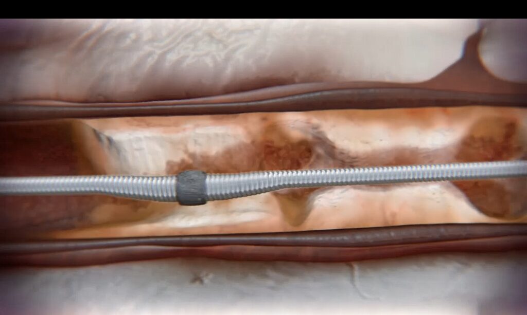 「 360 心臓動脈粥樣硬化切除器 」 ，以電動旋磨方式，磨走心血管内壁的鈣化物。