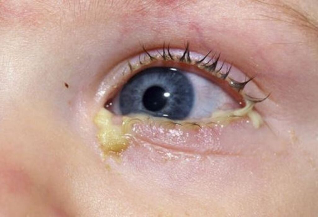 結膜炎病徵包括眼紅，眼痕，眼痛，眼腫，流眼水和眼分泌物。