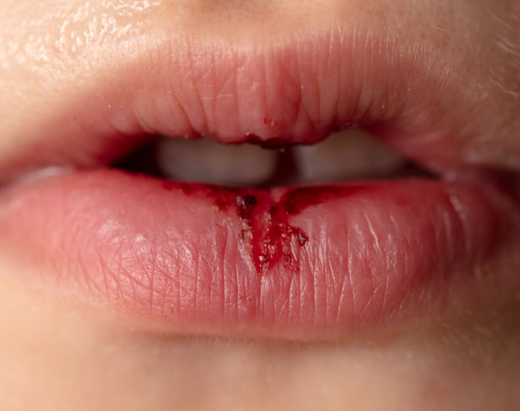 唇瘡主要由單純皰疹病毒引起，患者會痕癢、灼熱及疼痛。病發時，患處會有一堆小水泡，當小水泡穿破便會流出濃液，這時就是傳染度極高的時候。