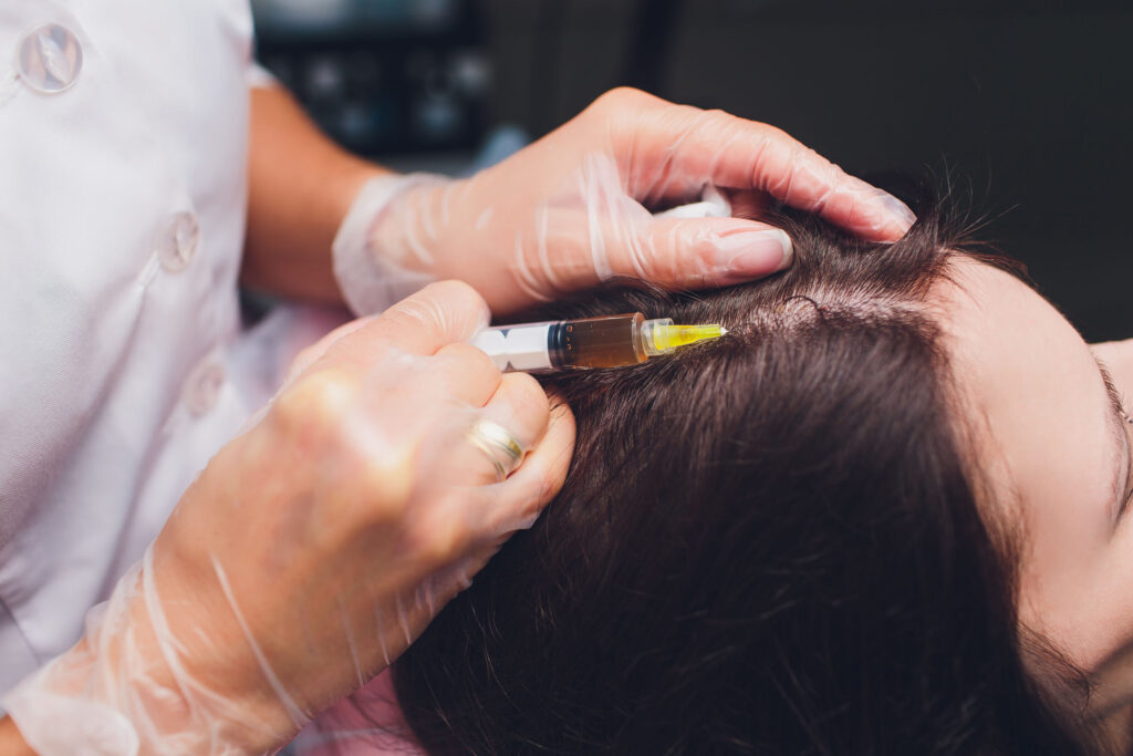 鬼剃頭可以用外塗藥物和俗稱頭皮針的類固醇針治療，但副作用不少，使用前要了解清楚。