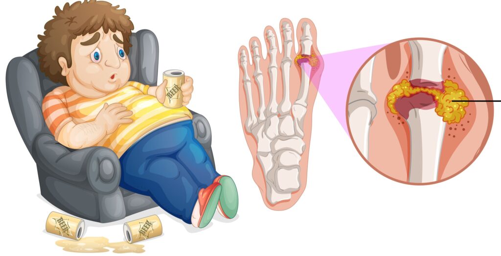 痛風在初期發作時通常影響較遠及體溫較低、尿酸容易沉積的腳趾關節。
