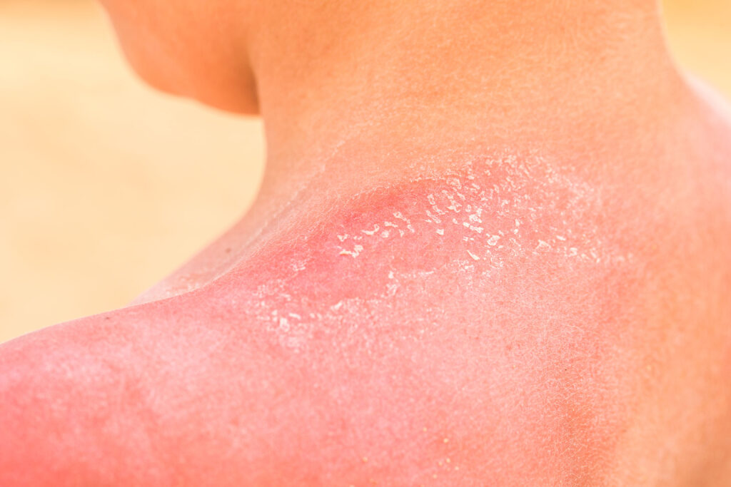 曬傷的症狀一般會在曬後12∼24小時會達到高峰，72小時內都屬於急性期，此時的肌膚異常敏感脆弱，重點要降溫、保濕、止痛及防感染。