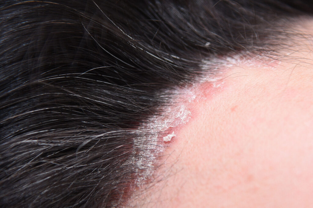 銀屑病多數發生在頭皮、手肘、耳背、膝蓋等
