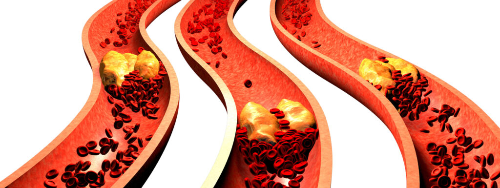 一般認為飲食中比例較高的飽和脂肪酸會增加心血管疾病和中風的風險，但也有研究指出飽和脂肪酸與心血管疾病的風險兩者間並無明顯的關係。