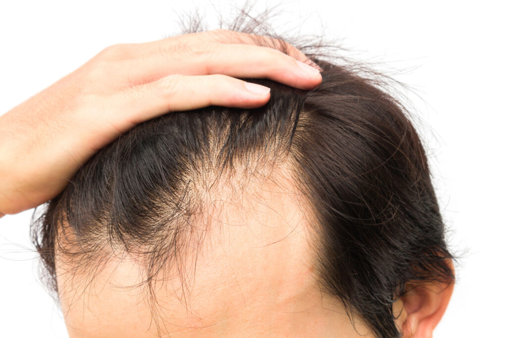 生髮藥所含的「非那雄胺」成份會抑制男性荷爾蒙，或削減精子質量，曾有男士因長期食用生髮藥而影響造人大計。