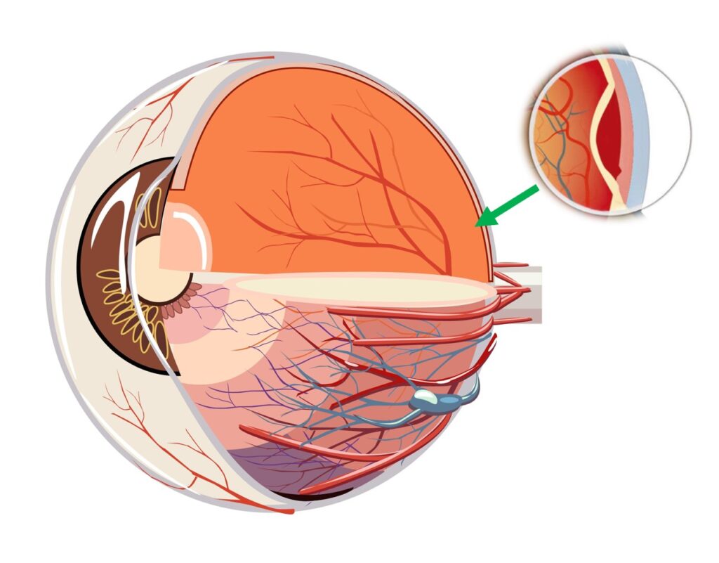 不當使用眼球操或眼睛按摩，有機會損害人工晶體及令視網膜脫落。