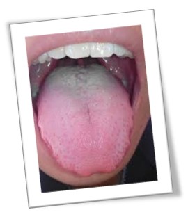 體內濕重，舌頭脹大，因此舌邊會有牙齒痕。