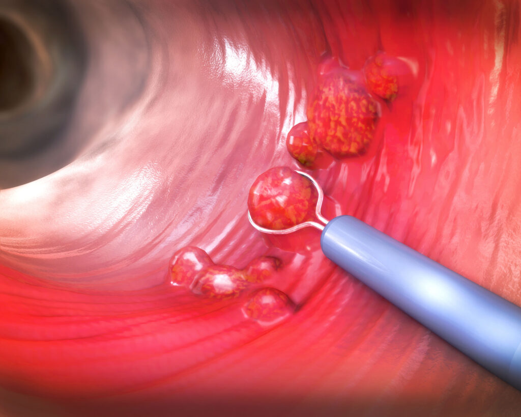 大腸癌是少數可以預防的癌症，大腸鏡檢查能及早發現瘜肉並加以切除，有效阻止瘜肉增大及演變為癌症。