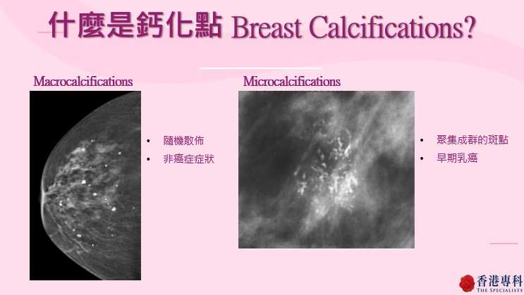 有鈣化點不等於是患癌，醫生會觀察鈣化點的形態，如發現聚集成群的斑點則是早期乳癌徵兆。