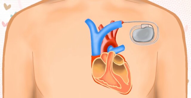 傳統起搏器需在胸口上方位置造個小切口，放入起搏器機身，電線經由血管連接心臟。