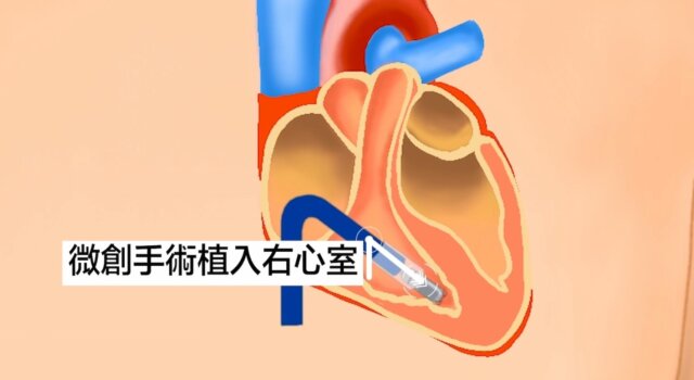 微型無導線起搏器可以經微創方法直接安裝於心臟內，令表面不留安裝痕跡。