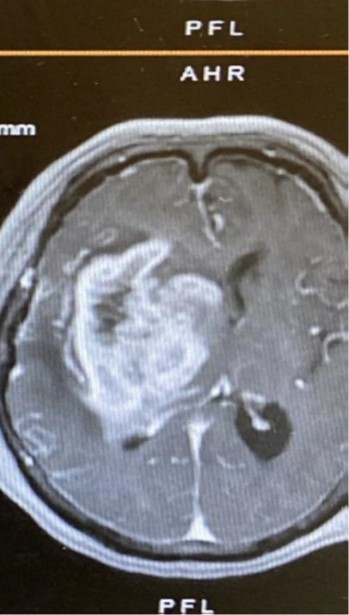 右腦一個體積容量很大的惡性膠質瘤的磁力共振掃描。