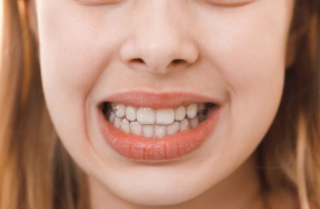 青春期有可能出現牙齦紅腫、出血