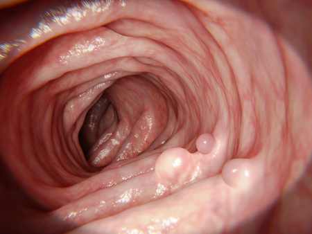 大腸鏡可檢查腸內圖中的瘜肉