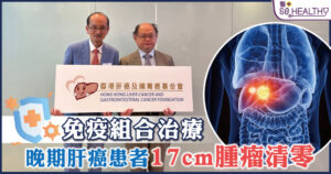 免疫組合治療 晚期肝癌患者 17cm腫瘤清零