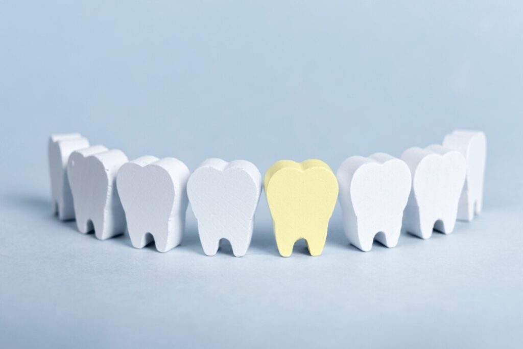 用牙套的4個主要原因，包括蛀牙、補牙、美觀、保護