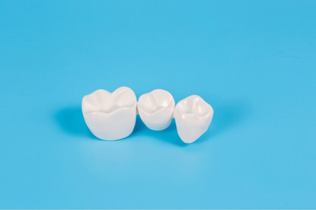 牙套有不同的製造物科，牙醫會按病人情況決定