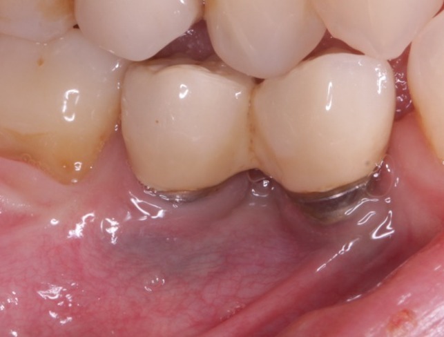 種植牙周圍保護性牙肉不足，刷牙不舒服，引致種植牙牙周病