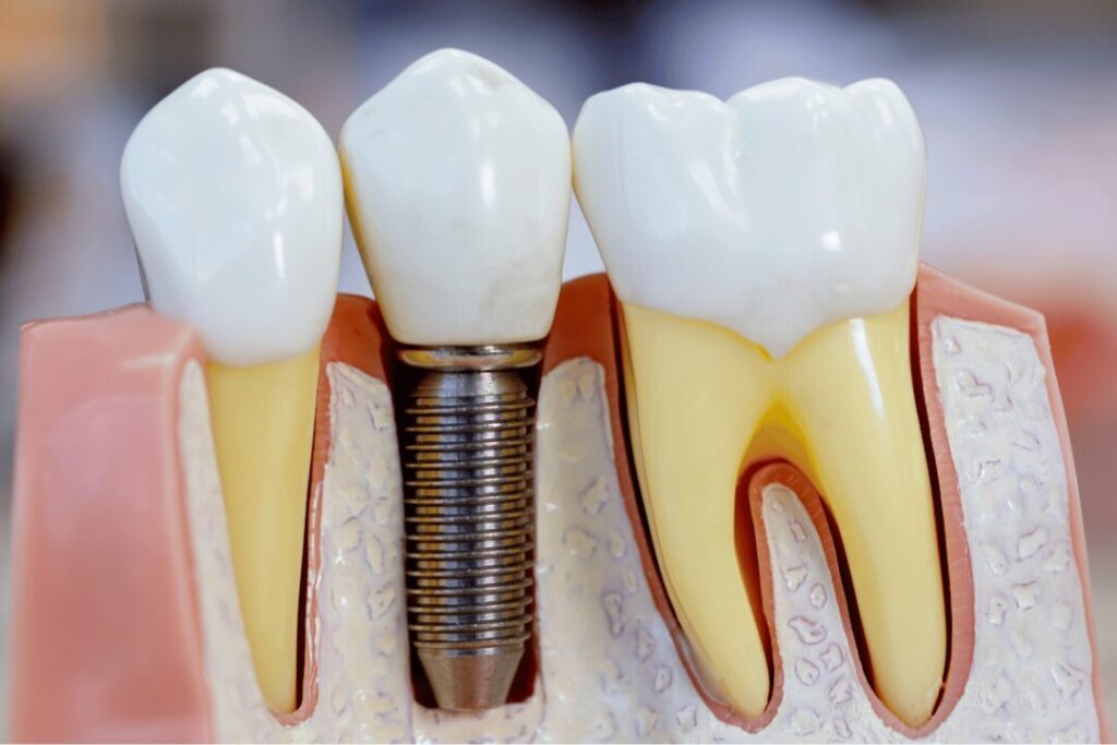 種植牙與天然牙有分別，不是用以直接取代原有牙齒
