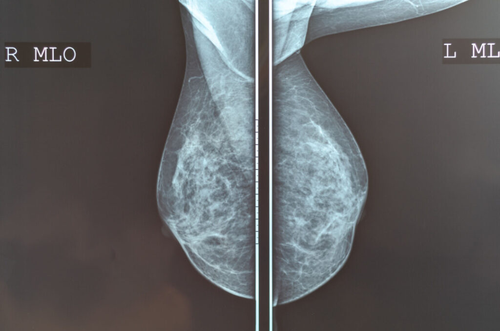 乳房 X 光造影可用於定位懷疑乳房組織的區域，萬一發現異常，再進行活檢。