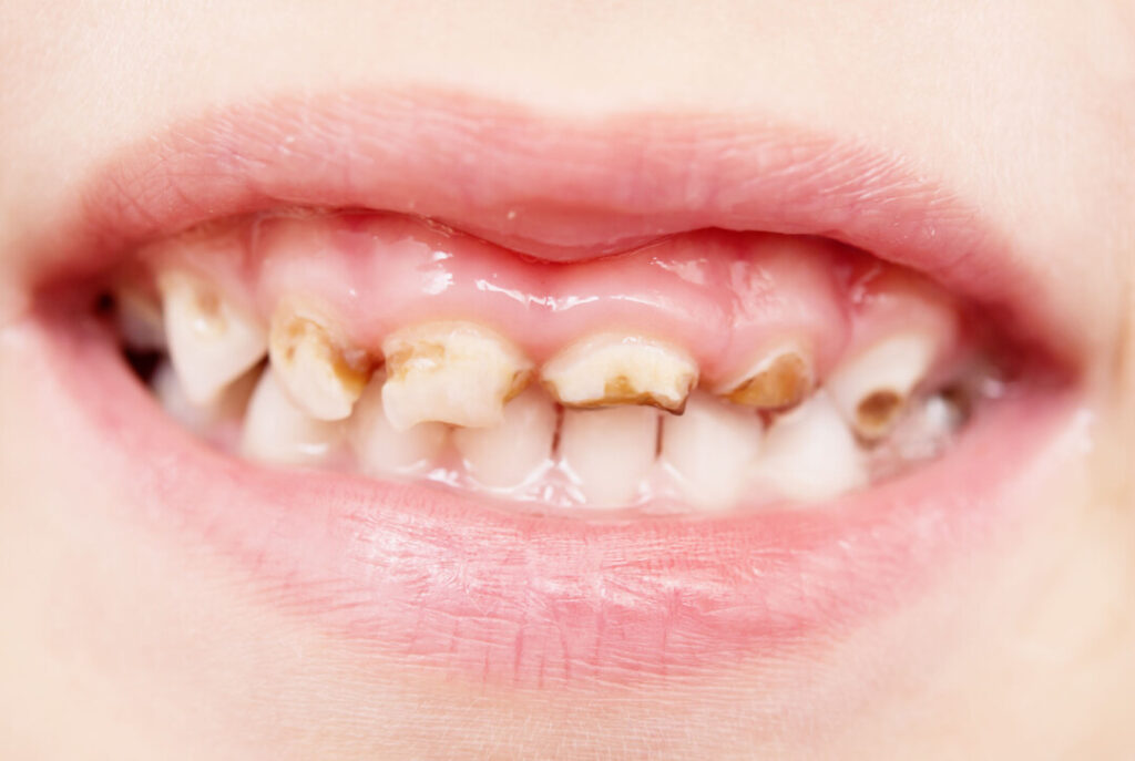 兒童牙齒問題：乳牙蛀牙應該儘快接受治療，否則有機會影響顎骨的發育。