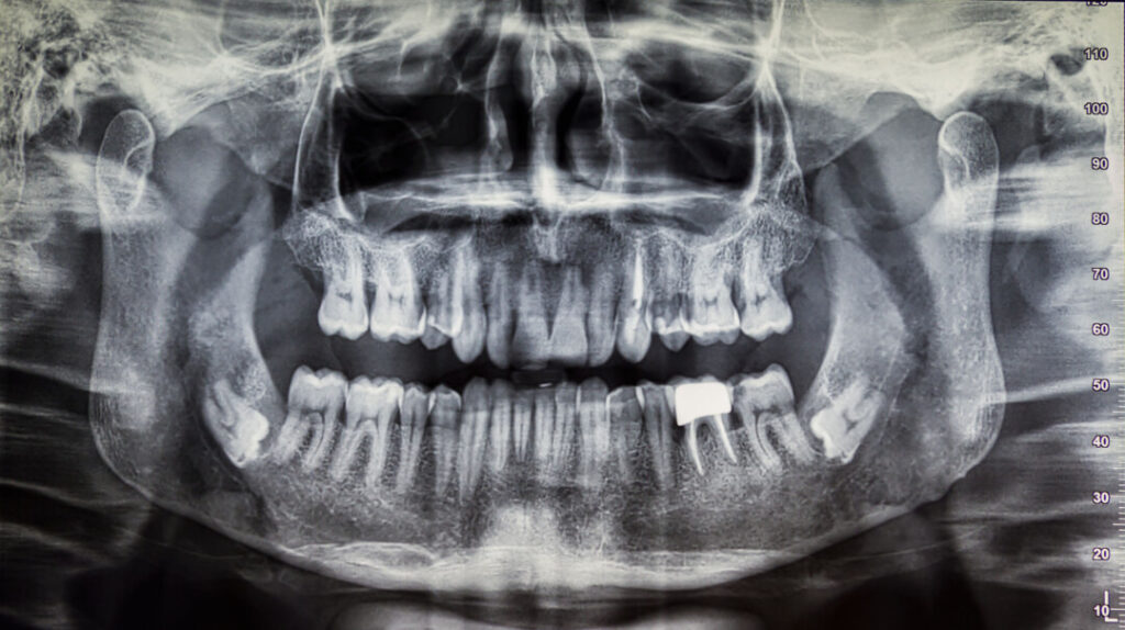 植牙前先要替患者進行詳細的口腔檢查和影像學分析，包括3D立體掃描X光，以制定最佳治療方案。