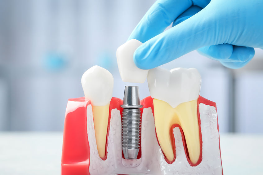 植牙可以固定在顎骨上，不會移動或滑動。