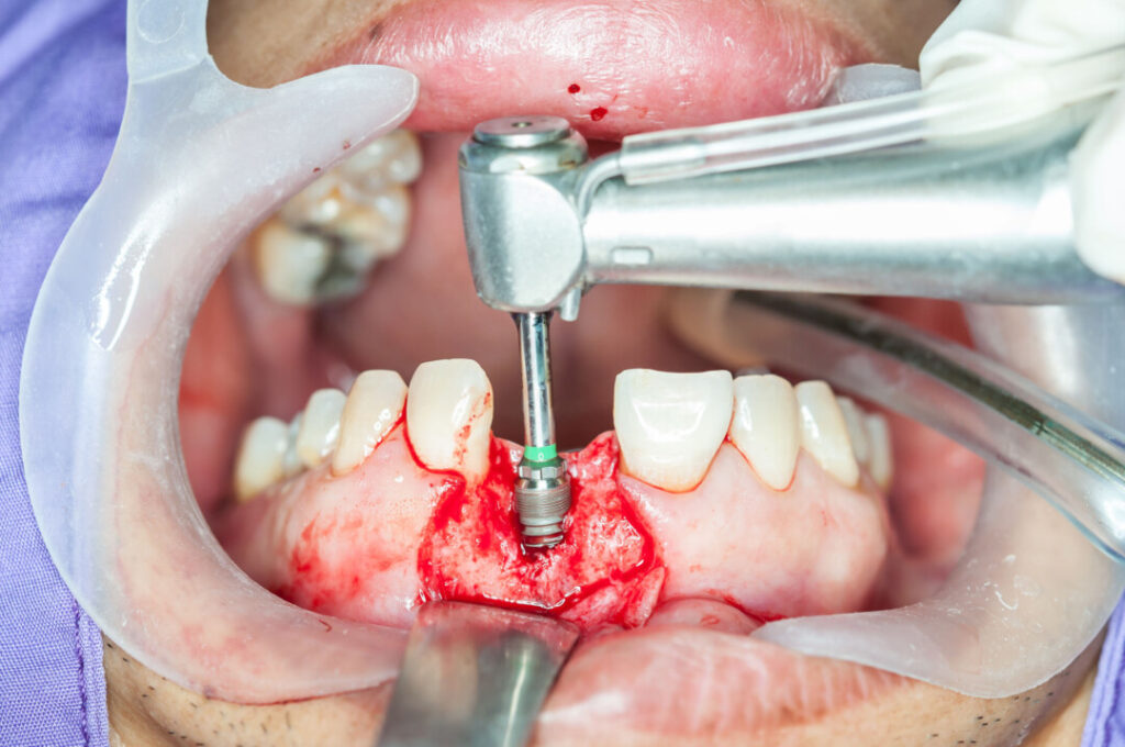 植牙的原理是將鈦金屬製成的植體（人工牙根）植入牙槽骨中，以建立一個穩固的基礎，然後，牙醫會在植體上鑲嵌牙冠，以取代缺失的牙齒。