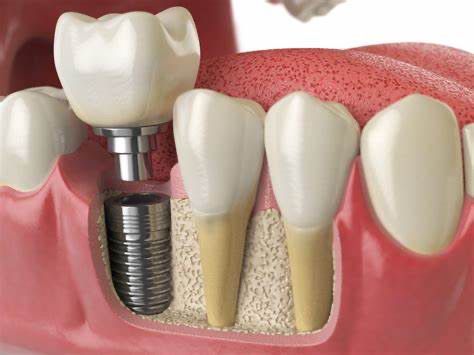 植牙可以固定在顎骨上，不會移動或滑動。