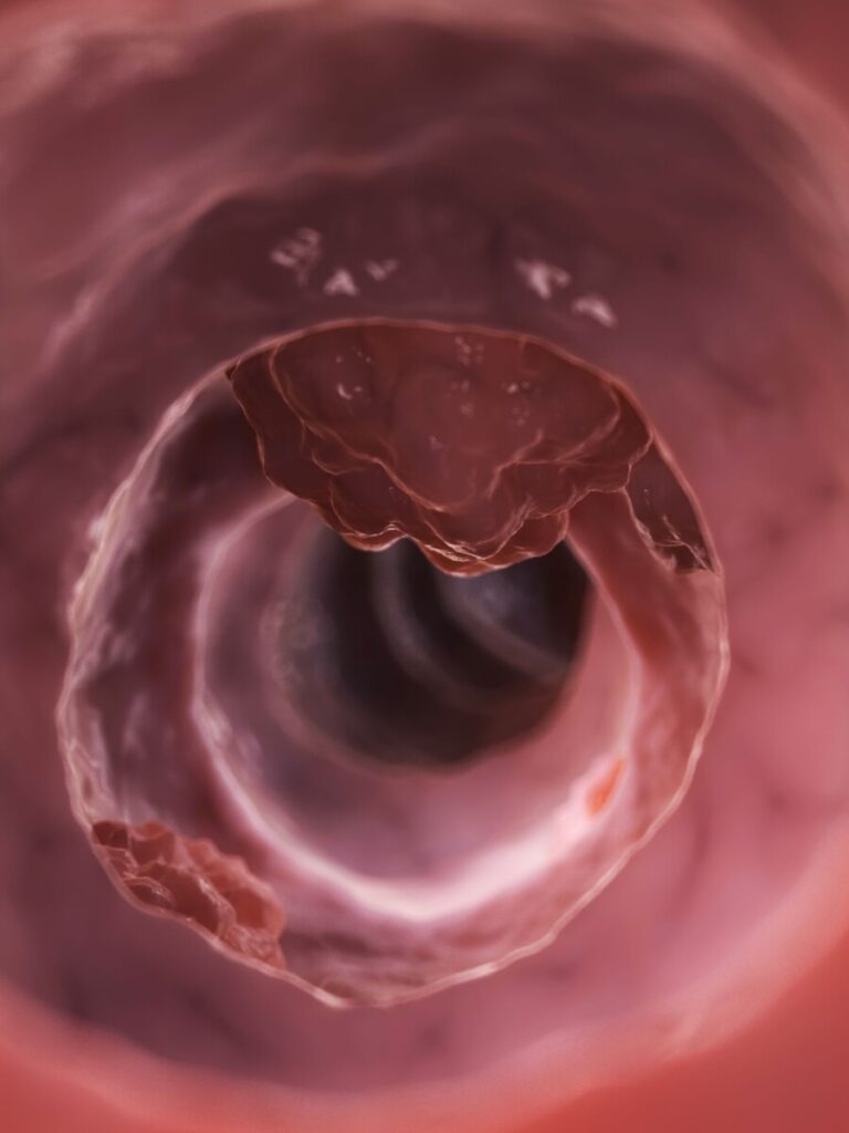 瘜肉是指消化道內腸壁上的腫瘤病變，可以出現在腸胃的任何部位，通常是由於黏膜層的增生形成。
