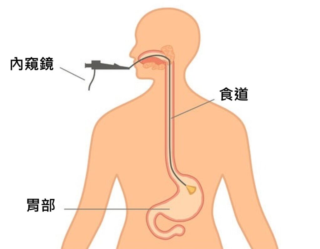 胃鏡檢查是透過口腔插入內窺鏡，沿食道推進至胃部及十二指腸。攝影鏡頭會將消化道影像傳送至螢幕。